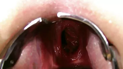 Prolapse រុស្ស៊ី